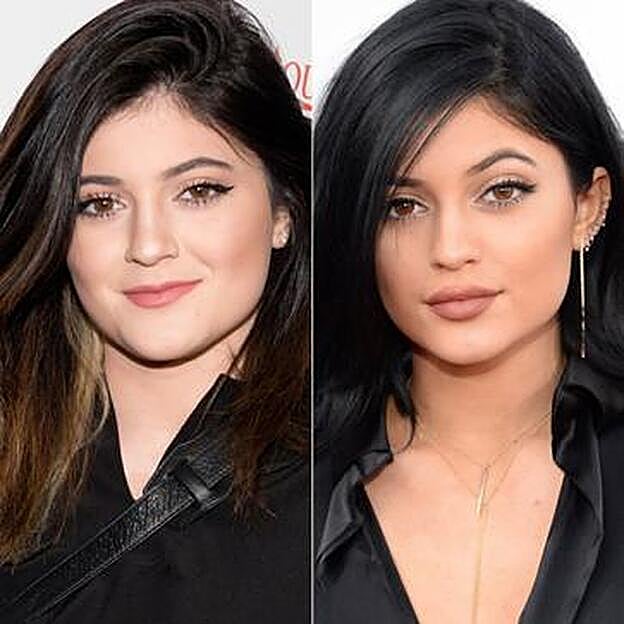Kylie Jenner, antes y después de someterse a un tratamiento para aumentar el tamaño de sus labios.