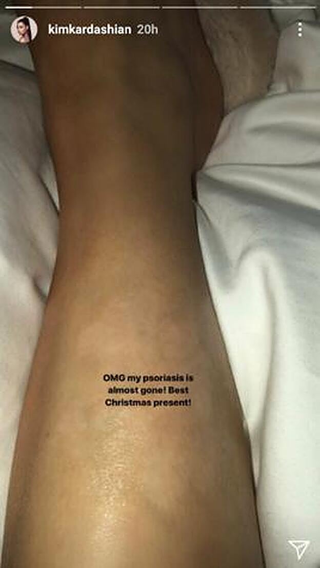 Kim Kardashian muestra su recuperación en la zona afectada por psoriasis.