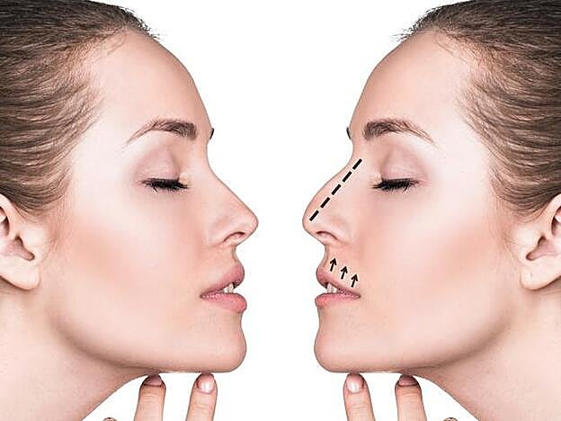 Antes y después de una rinomodelación