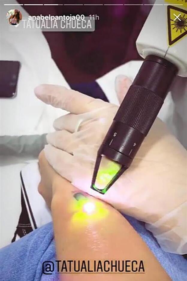 Así se está borrando Anabel Pantoja su tatuaje.
