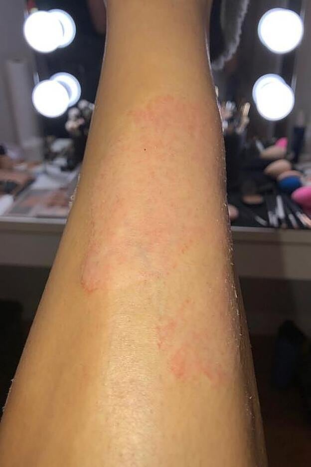 Este es el aspecto de las ronchas que le salen en los brazos a Kim Kardashian cuando tiene un ataque de psoriasis.