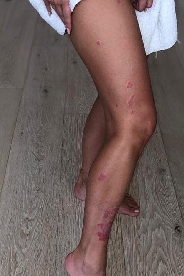 Impresionante el aspecto de las piernas de Kim Kardashian cuando tiene una crisis de psoriasis.
