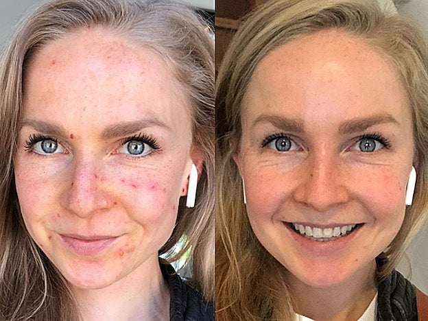 La comparación de una piel antes y después de un ataque de rosácea.