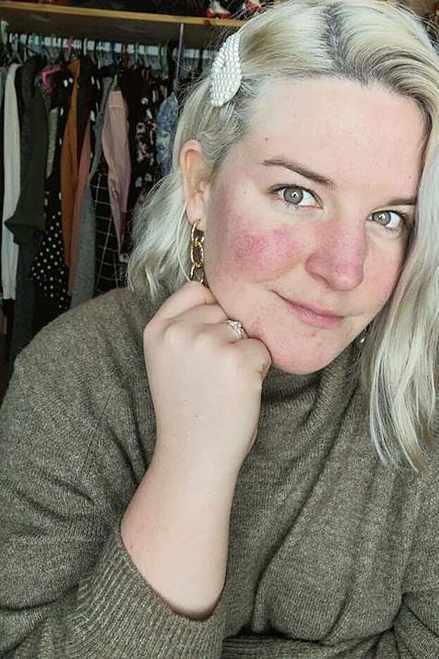 La protección SPF es vital para combartir este tipo de manchas.