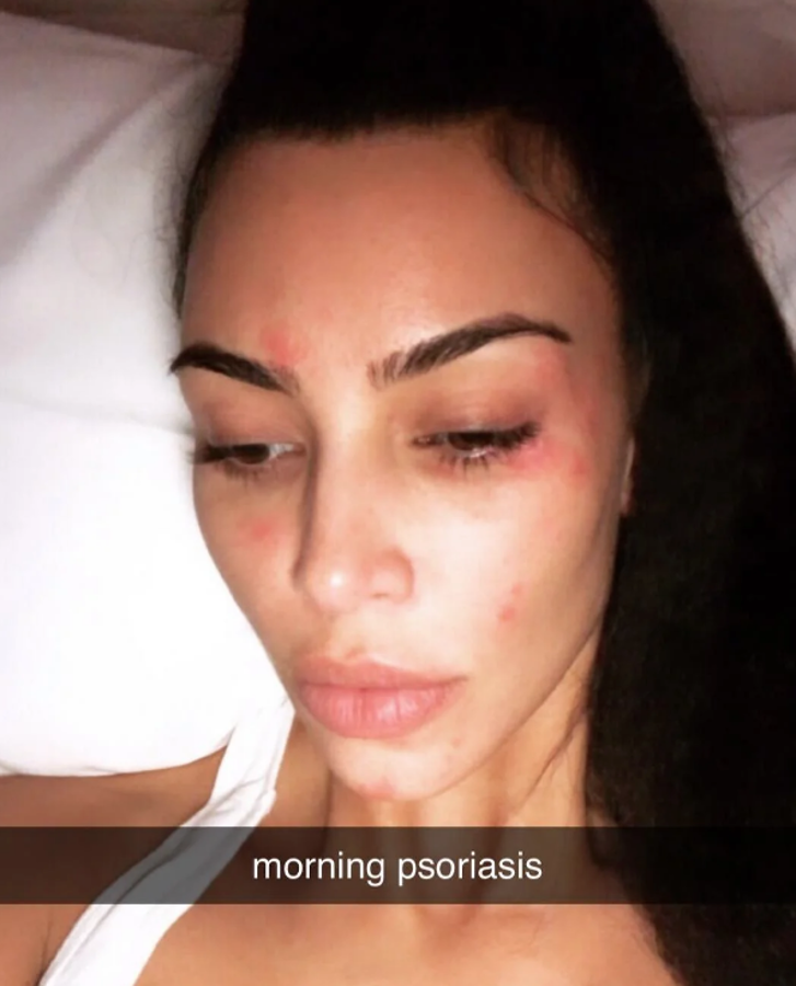 La influencer más poderosa del mundo y estrella de los 'realities' ha mostrado en Instagram uno de sus secretos de belleza: sufre de soriasis, también en la cara. De hecho, una de sus colecciones cosméticas se basó en productos para disimular esta coloración roja de la piel. Así luce su cara por la mañana, en pleno brote.