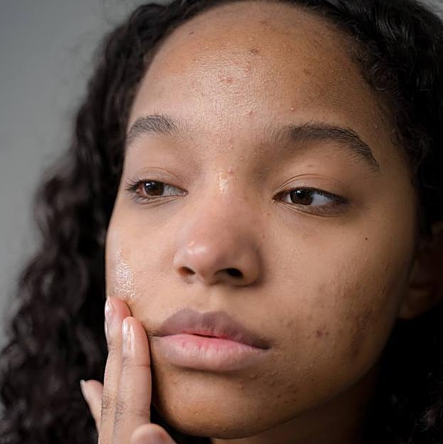 Mujer con piel acneicaa