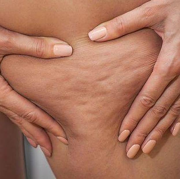 Mujer con celulitis en los muslos
