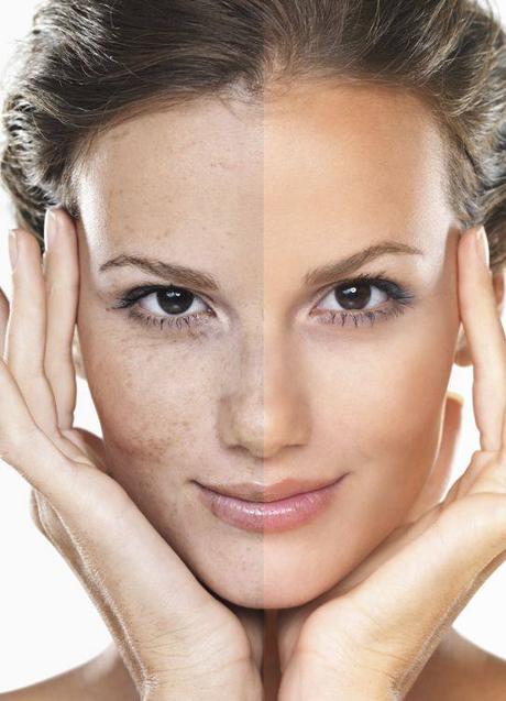 Imagen - Antes y después de cara con manchas