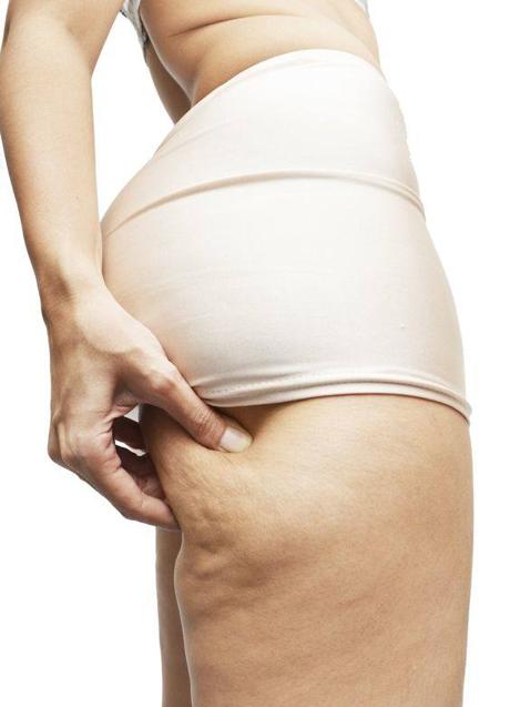 Imagen - Mujer con celulitis