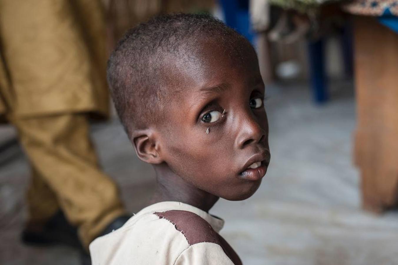 Un niño que sufre de desnutrición aguda grave sentado en una de las clínicas de nutrición de Unicef en Manila, Nigeria.