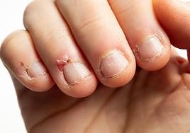 ¿Por qué no es buena idea arrancarse los padrastros?