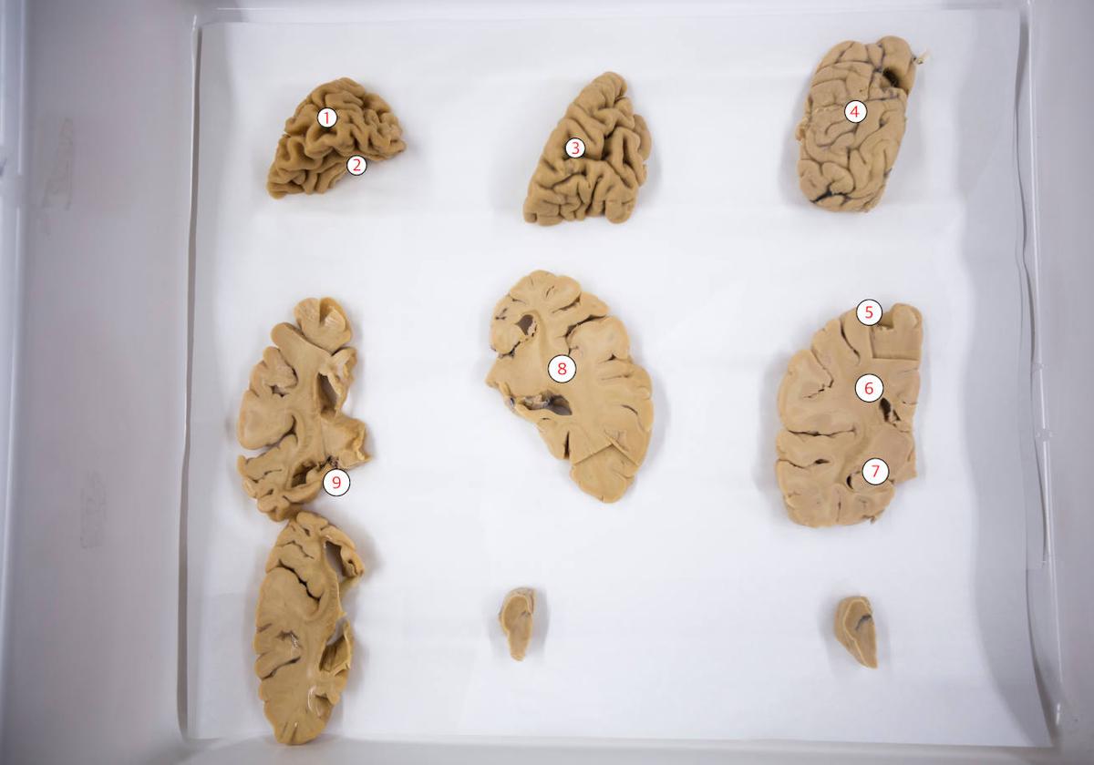 Tres cortes de cerebros: uno sano (#4) y dos afectados, con alzhéimer (#1, 2, 8 y 9) y párkinson (#3)