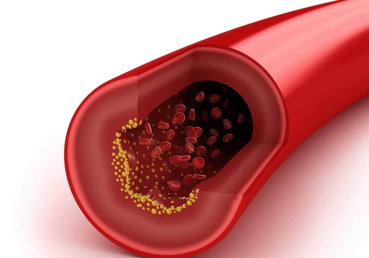 Injections that reduce cholesterol arrive in Spain - Pledge Times