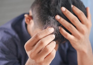 No vayas a Turquía: aquí tienes los mejores tratamientos para la alopecia