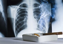 El tabaquismo es el detonante de casi el 90% de los cánceres de pulmón.