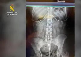 Radiografía de uno de los detenidos con varias decenas de bellotas de hachís en su organismo.