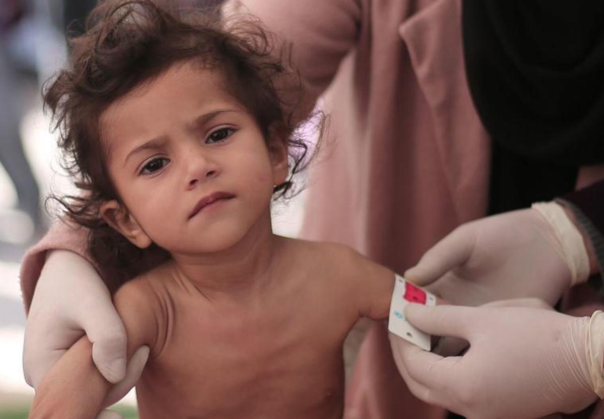 Un voluntario sanitario mide el grado de desnutrición de un niño en la Franja.