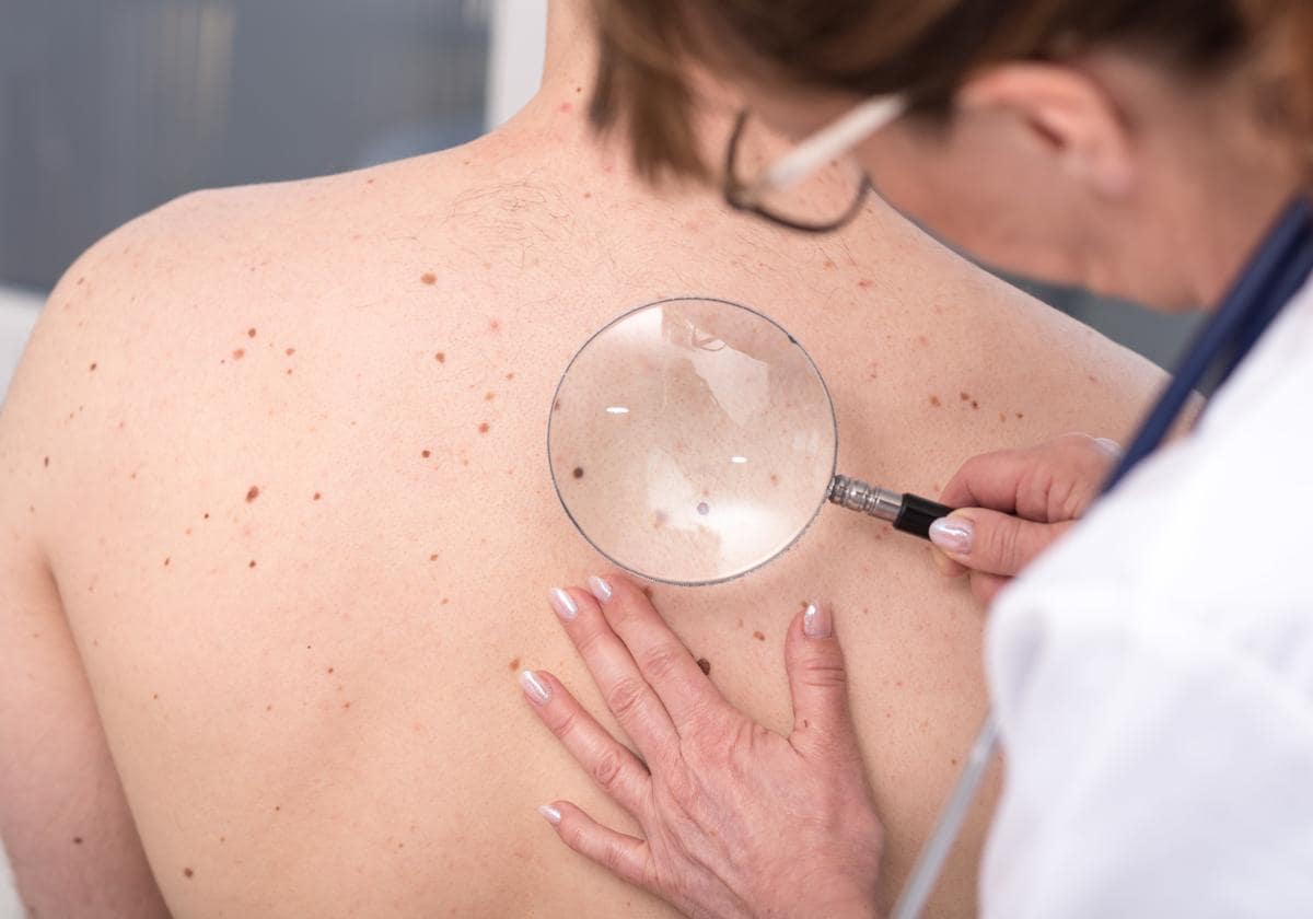 Una dermatóloga observa los lunares de la espalda de un paciente.