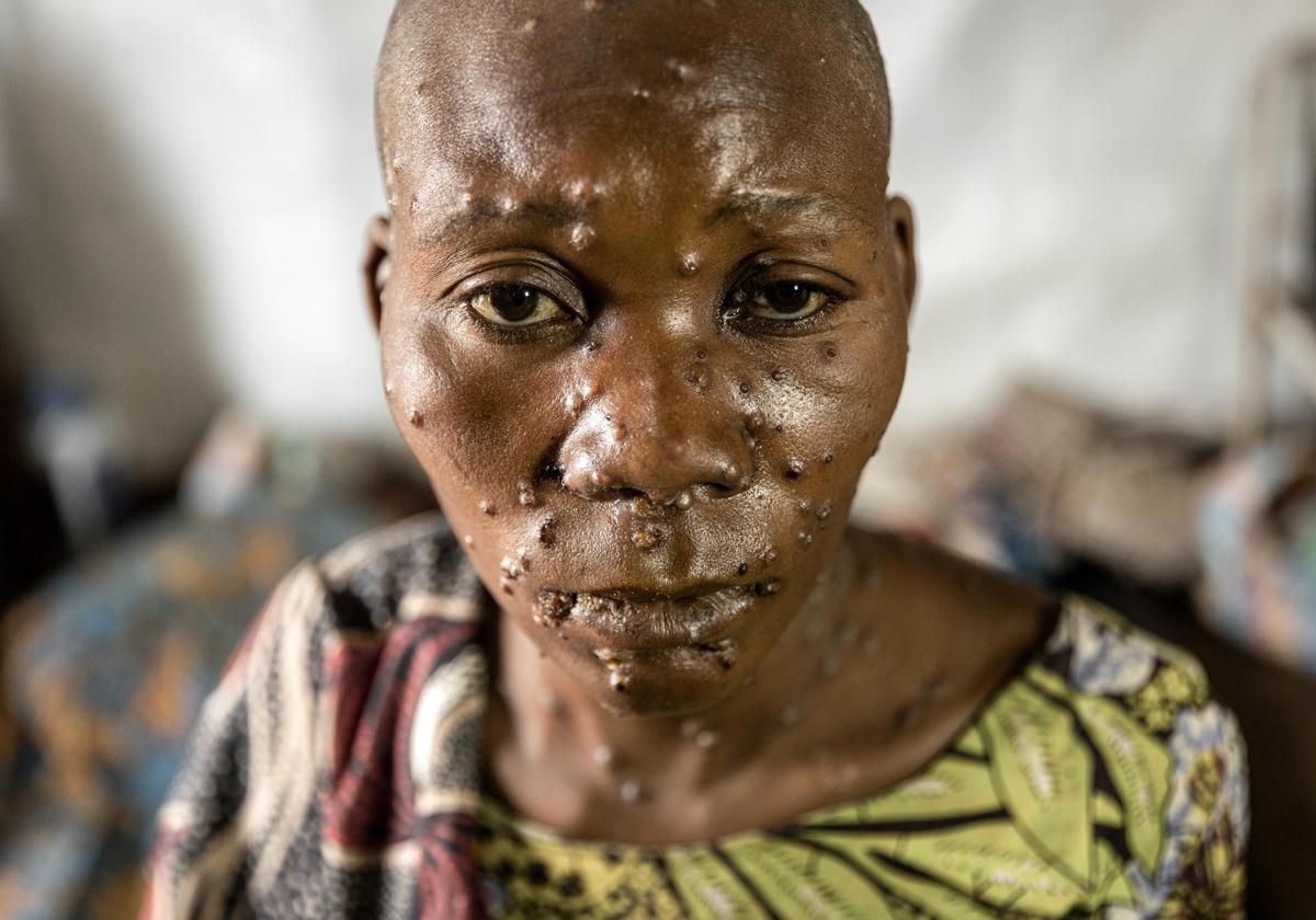 Una mujer infectada por el mpox en África.