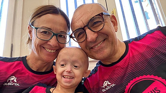 Alexandra, la única niña de España con el síndrome que acelera el envejecimiento