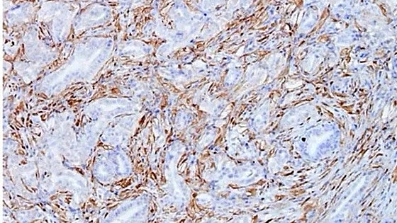 Un estudio detecta una de las claves de la alta agresividad del cáncer de páncreas