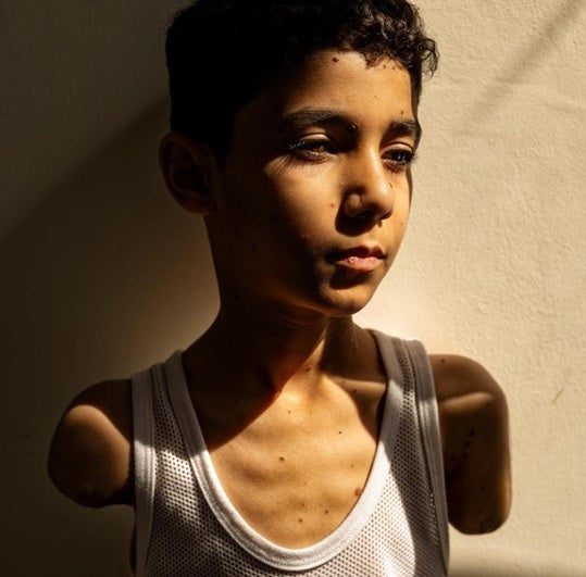 El horror de la guerra de Gaza en un niño mutilado, Foto del Año 2025