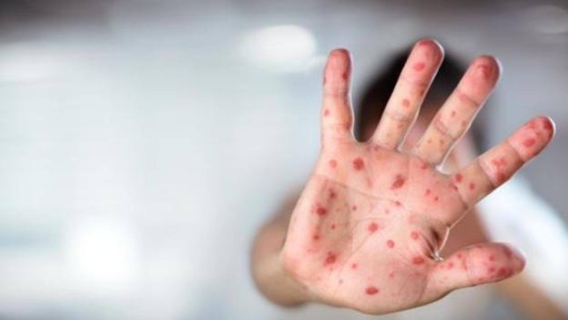 La UE alerta del aumento del sarampión por la caída de las tasas de vacunación