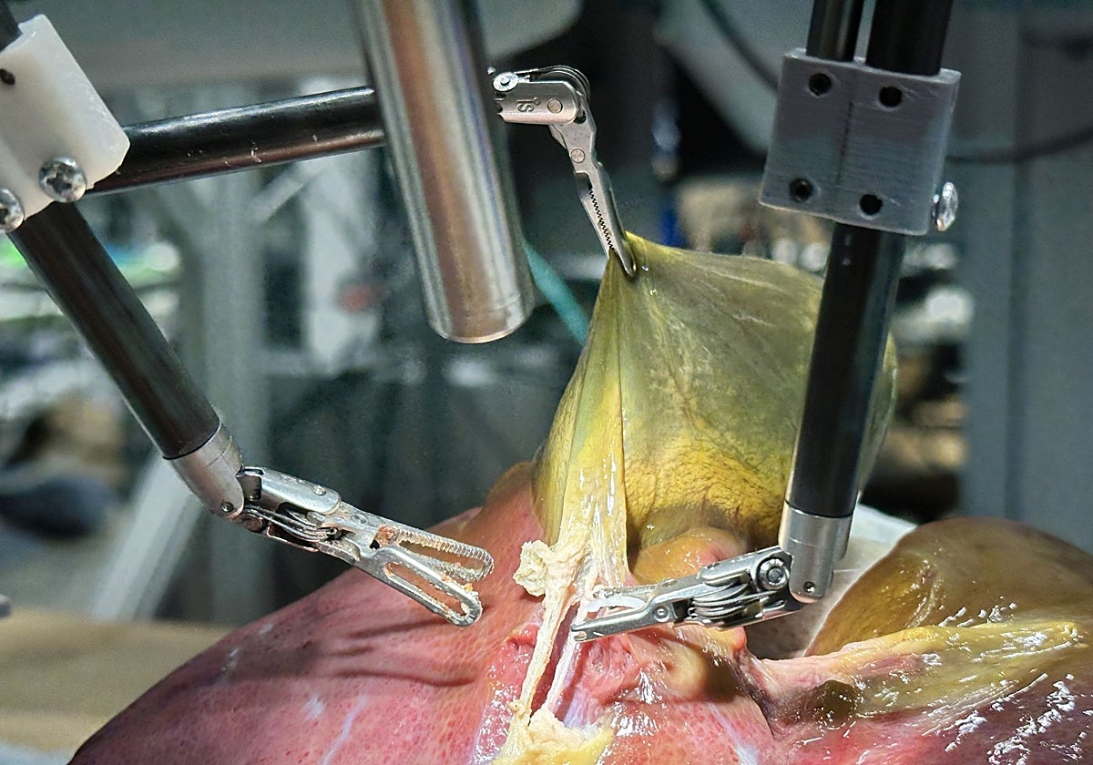 El robot SRT-H, durante la extirpación de una vesícula biliar a un ser humano.