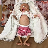 Una niña gazatí de cinco meses recibe tratamiento en Jan Yunis.
