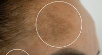 Melasma