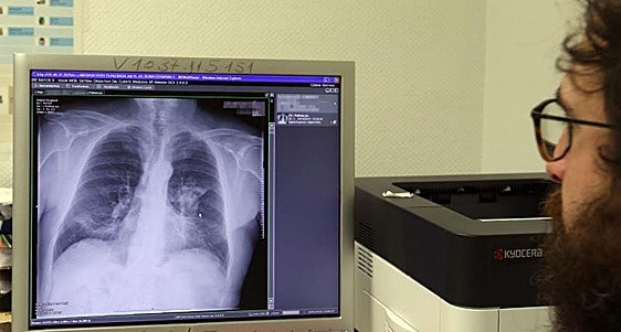 España es el país europeo en el que más crece el cáncer de pulmón femenino