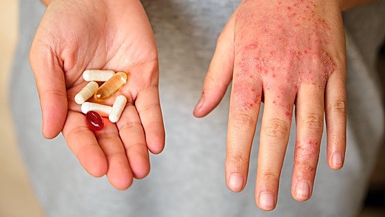 Dermatitis atópica, una enfermedad que te quita el sueño y afecta al crecimiento de los niños
