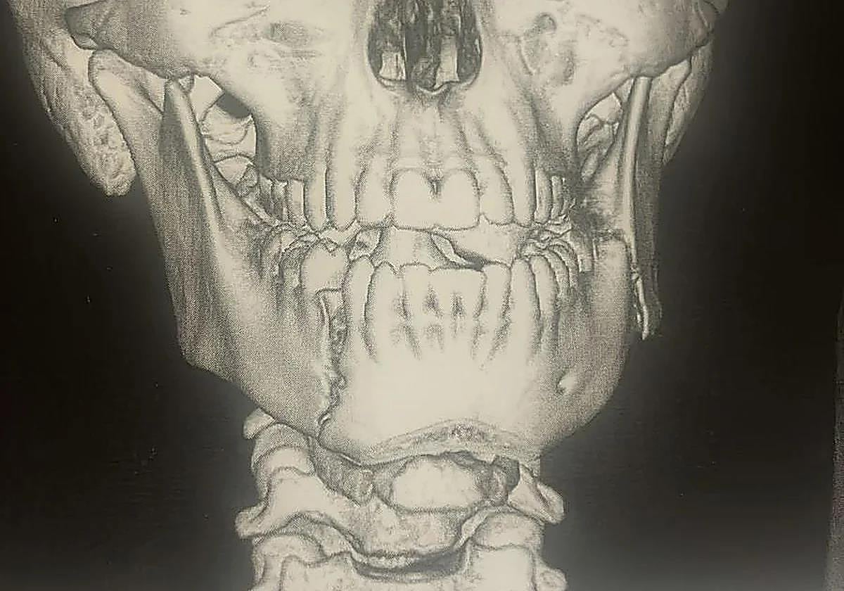 Un menor de 14 años, hospitalizado tras una grave agresión en un instituto de Fuengirola