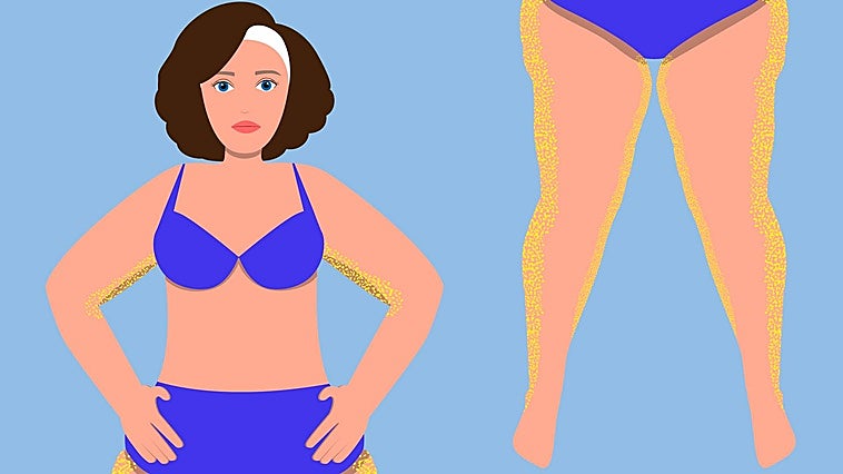 Esa grasa que se acumula en las piernas... ¿Es celulitis o lipedema?