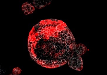 Organoide de cáncer colorrectal con células malignas marcadas en rojo.
