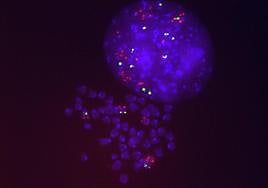 Células del cáncer de pulmón resistentes al Sotorasib que presentan varias copias del gen KRAS mutado (en rojo).