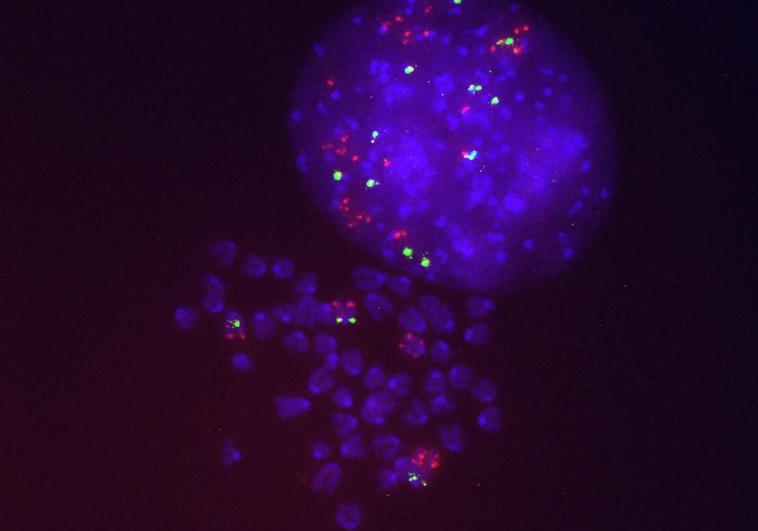 Células del cáncer de pulmón resistentes al Sotorasib que presentan varias copias del gen KRAS mutado (en rojo).