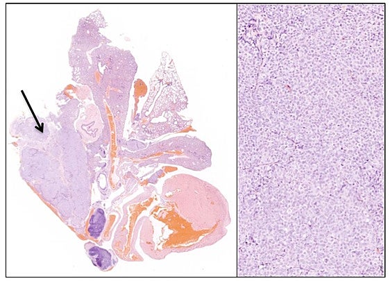 Nuevos abordajes farmacológicos en cáncer de pulmón resistente a tratamiento
