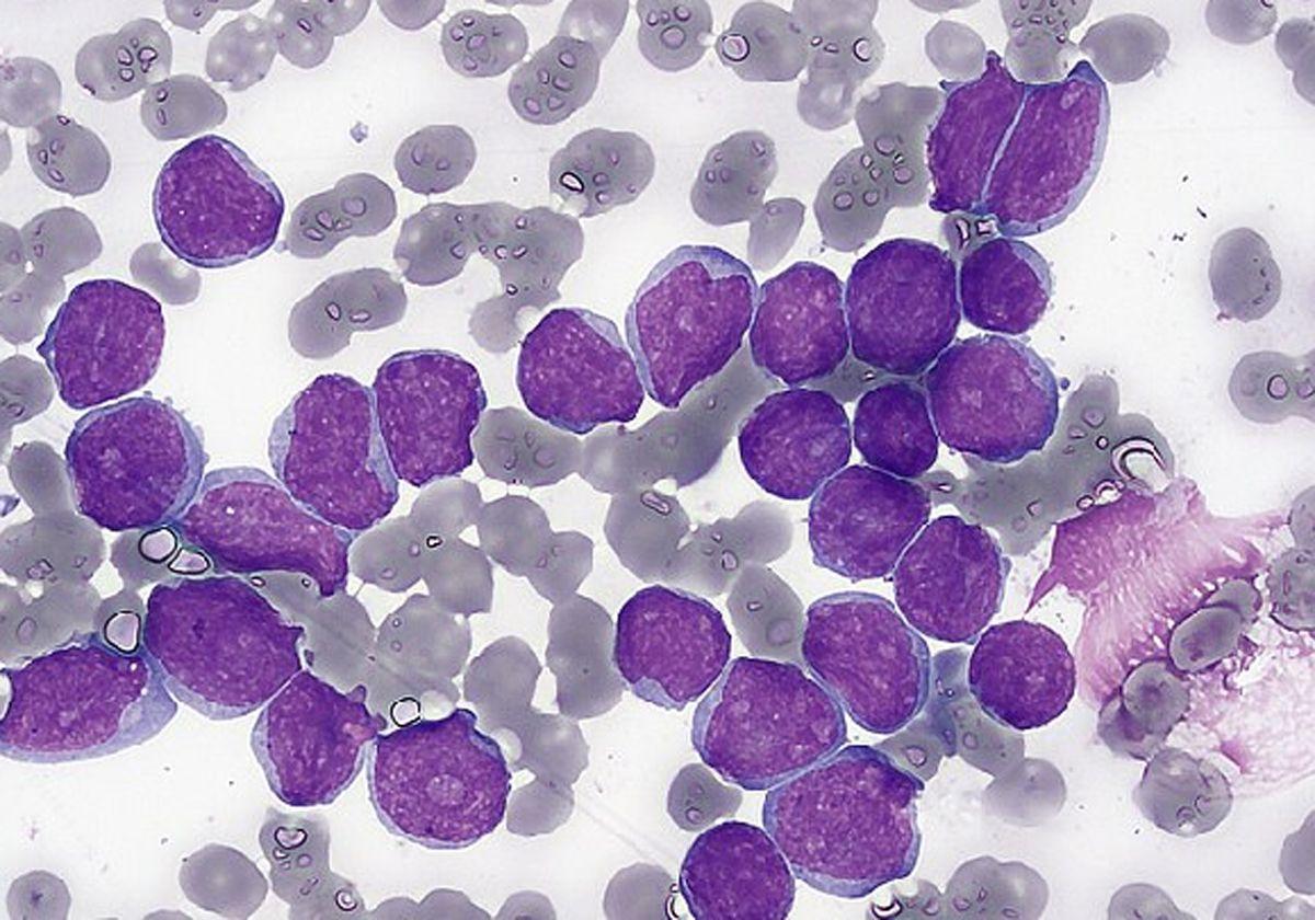 Investigadores del CIC participan en un proyecto para detectar de forma precoz el riesgo de leucemia infantil