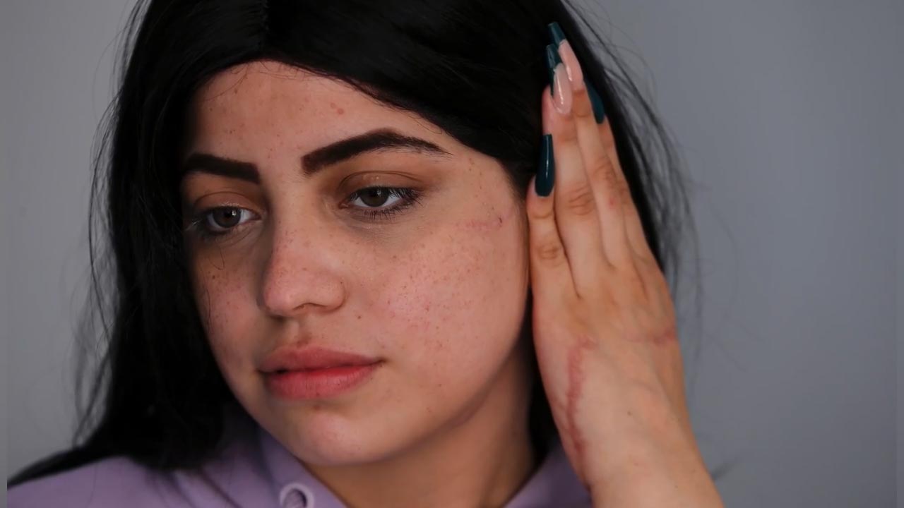 Imagen principal - María, 18 years old and 27 scars that tell of a miracle