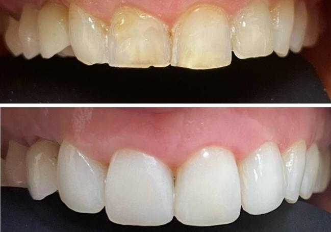 Before and after aesthetic dental treatment.