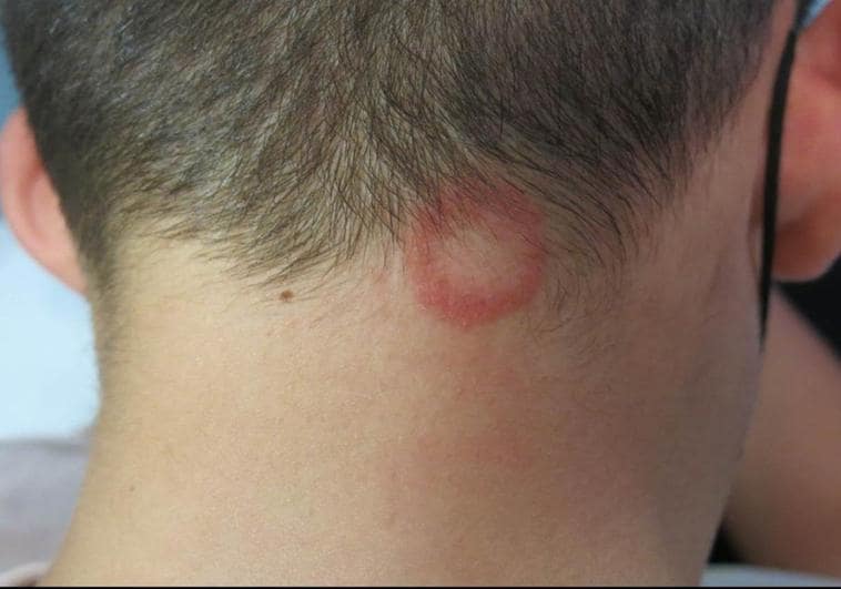 Cases of scalp ringworm caught at low-cost hairdressers, experts warn