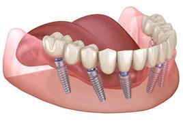 Harmonia Dental, fixed teeth in one day, a latest generation treatment