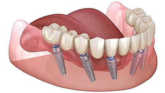 Harmonia Dental, fixed teeth in one day, a latest generation treatment