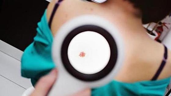 Malaga university researchers develop tool based on artificial intelligence to improve detection of melanomas