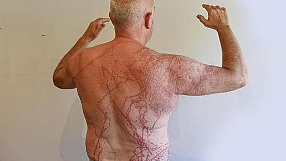The sting of a Portuguese man o' war: 'It was one of the worst days of my life and at times I thought I was going to die'