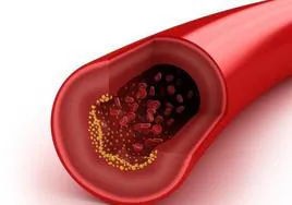 New cholesterol treatment arrives in Spain with two jabs a year to help reduce it