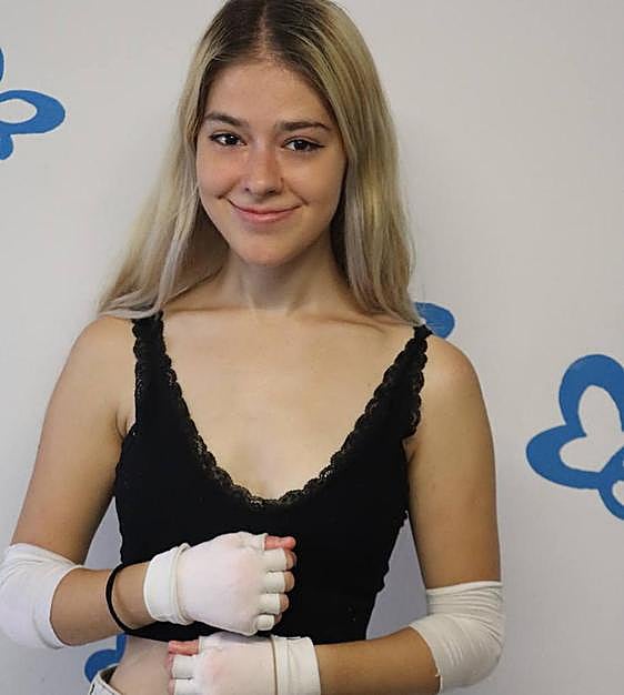Living with butterfly skin disease