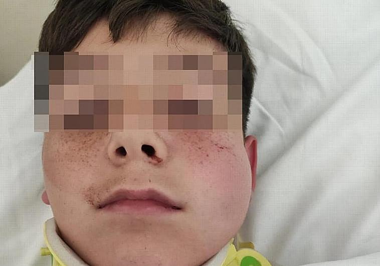 Íker, receiving treatment at the Costa del Sol Hospital, shortly after the alleged attack.