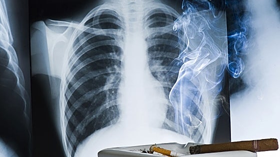 Spain rolls out national pilot screening programme for early detection of lung cancer